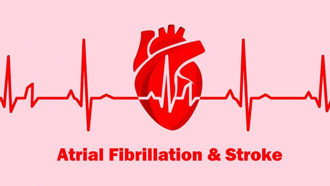 Atrial Fibrillation - How can it cause a stroke?